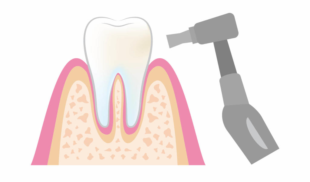 歯　クリーニング
